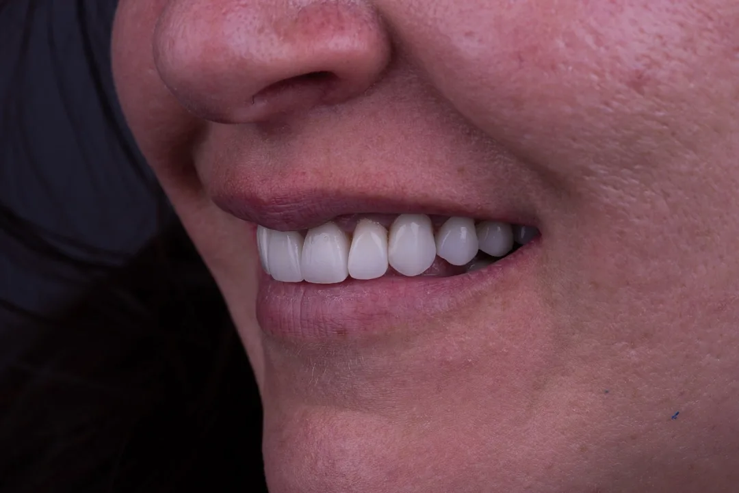 08: Full Mouth Rehabilitation