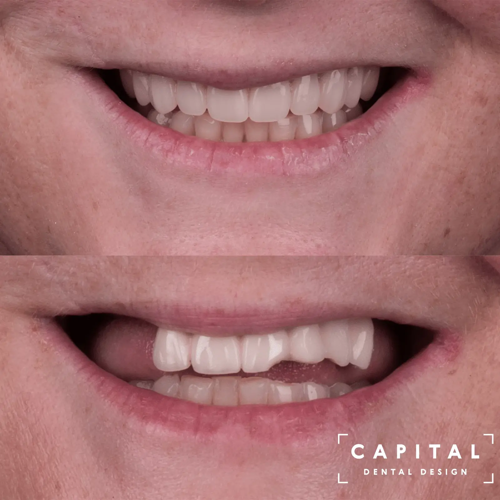 Smile Design results at Capital Dental Design Richmond VA