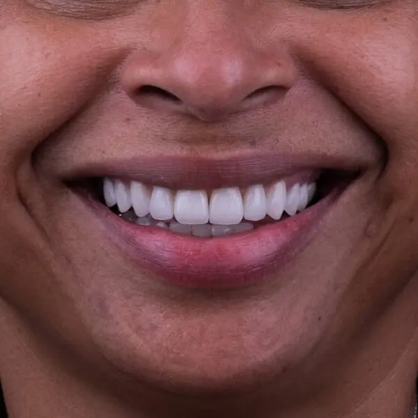 Smile result detail