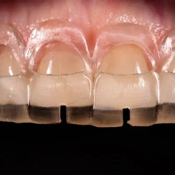 Surgical guide for gum recontouring