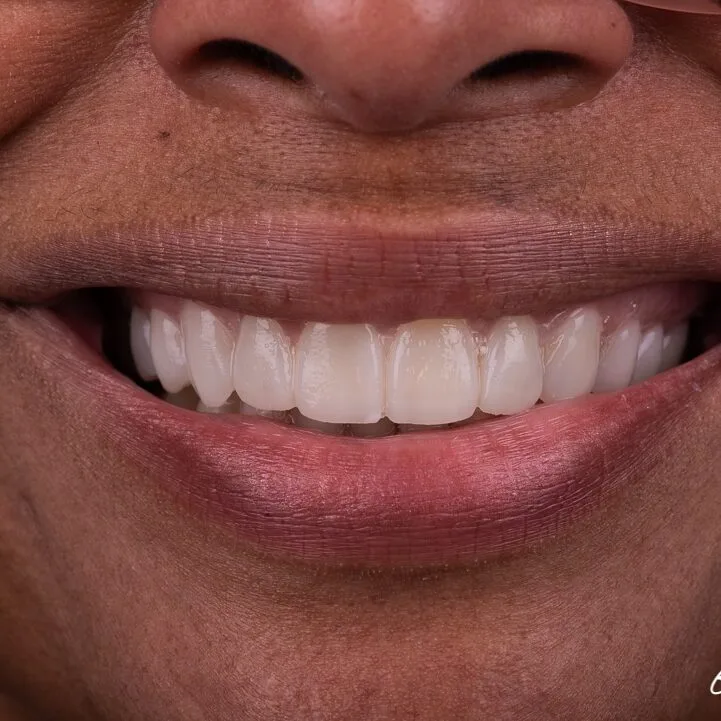 Step 4: Micro design verification at tooth level