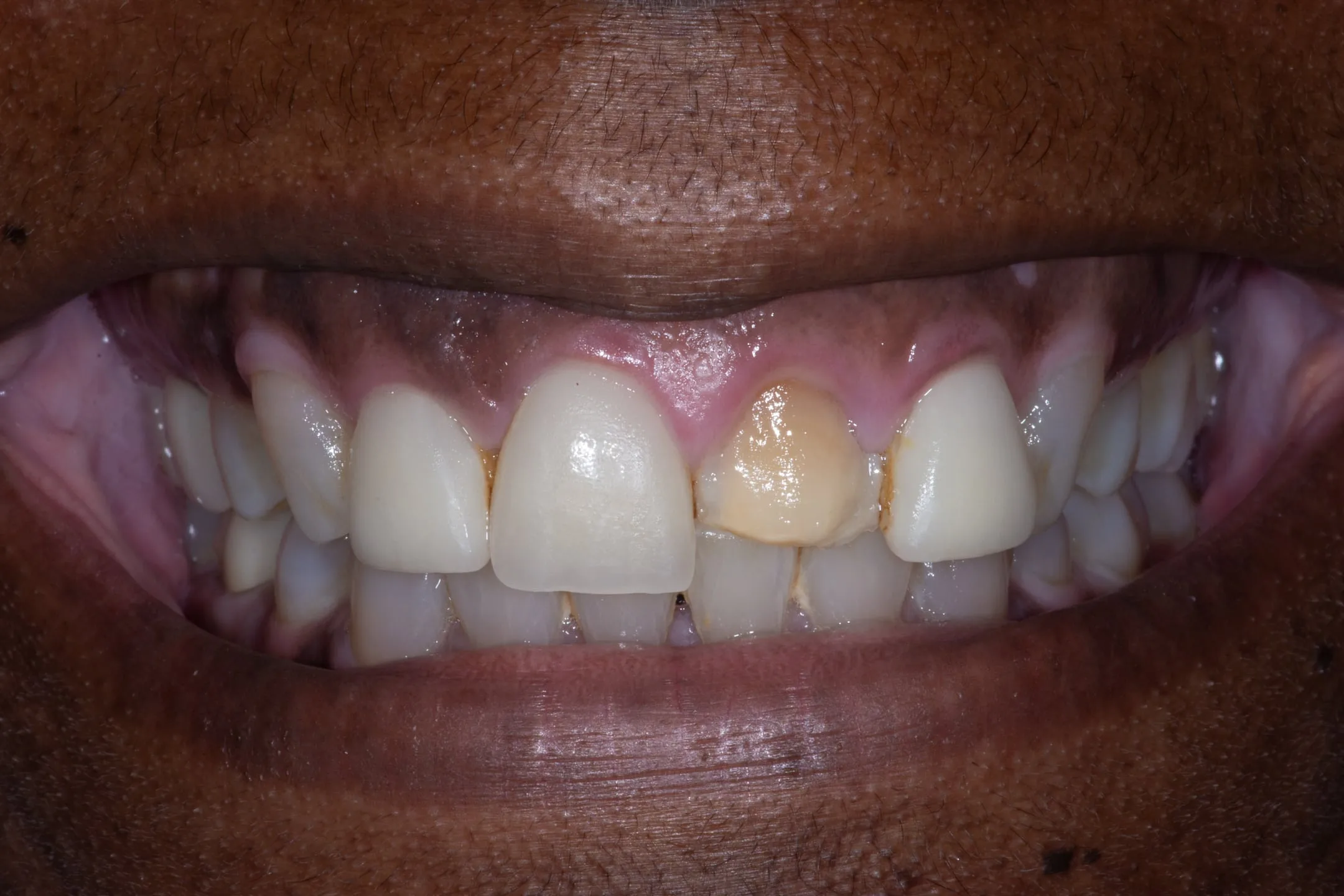 Porcelain Veneers case at Capital Dental Design