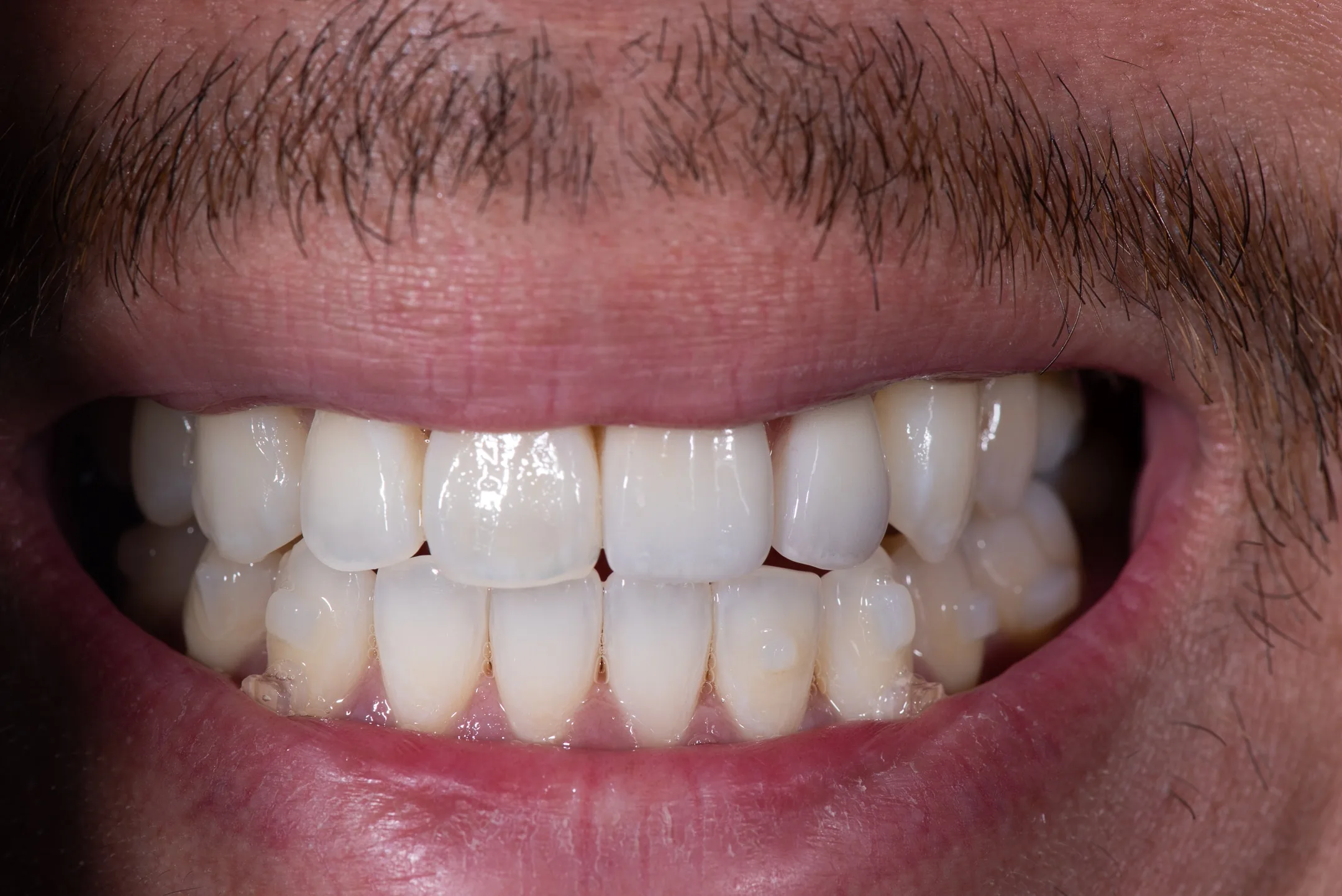 Case 13: Implant Prosthetics