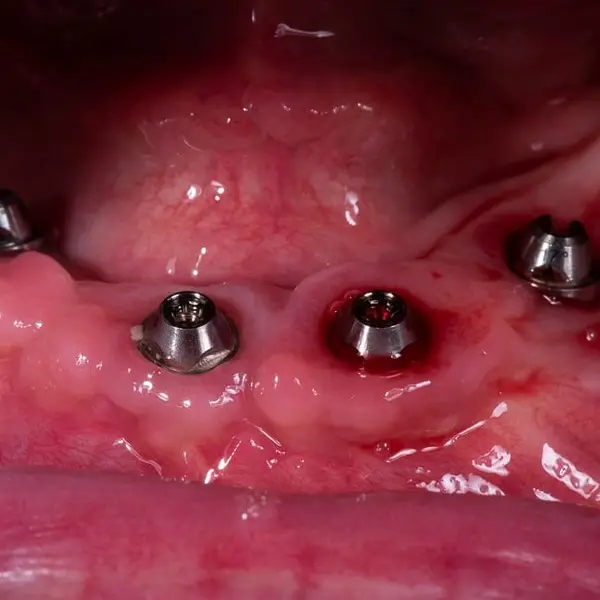 Healed implants