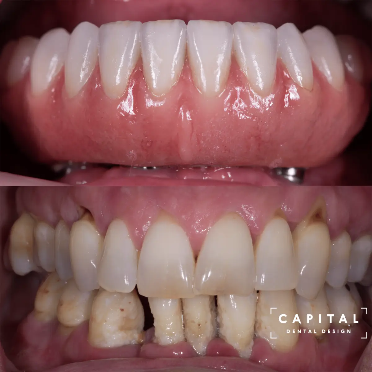 All-on-4 implant case