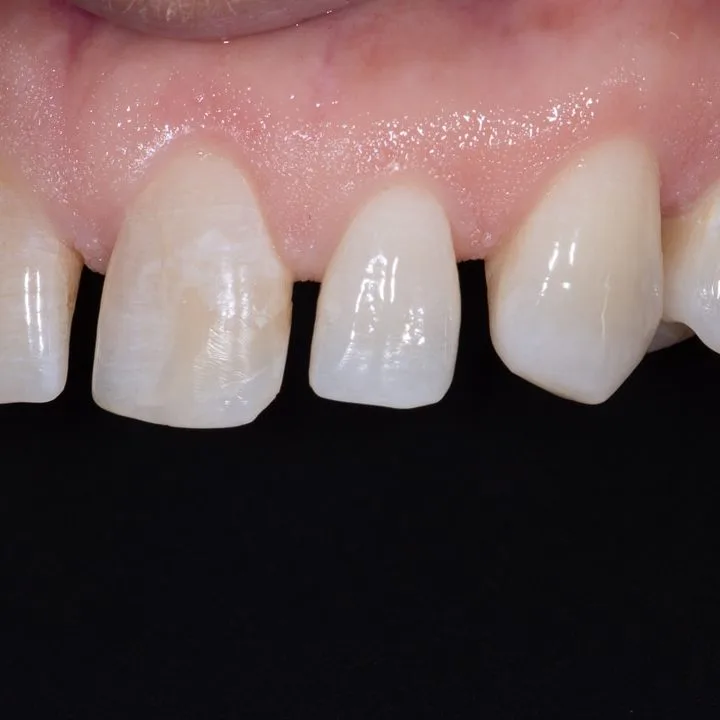 Step 2: After Invisalign