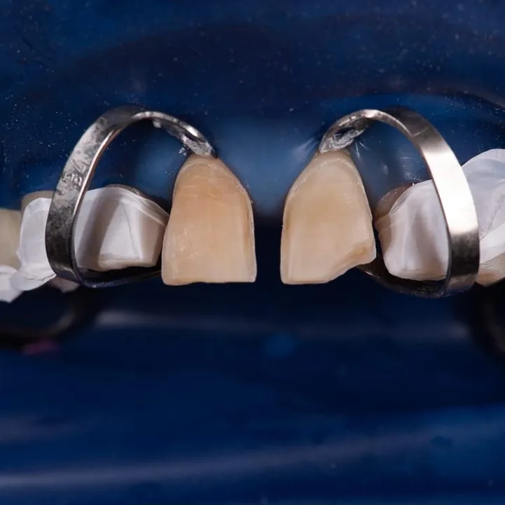 Step 4: Veneer delivery