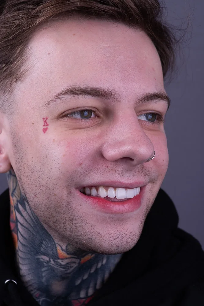 Step 12: Final Veneers