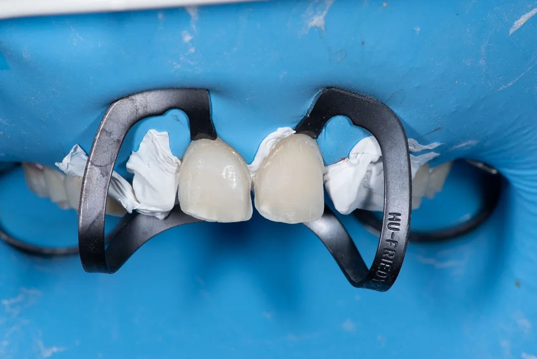 Step 9: Temp Veneers
