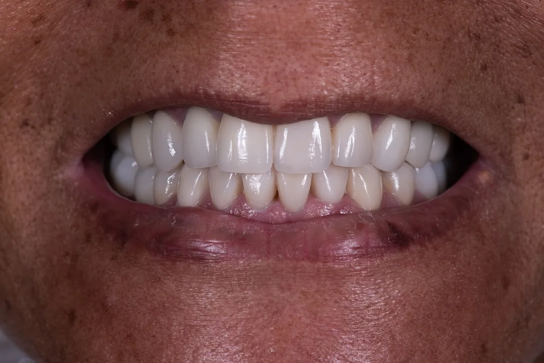 Full Mouth Restoration case