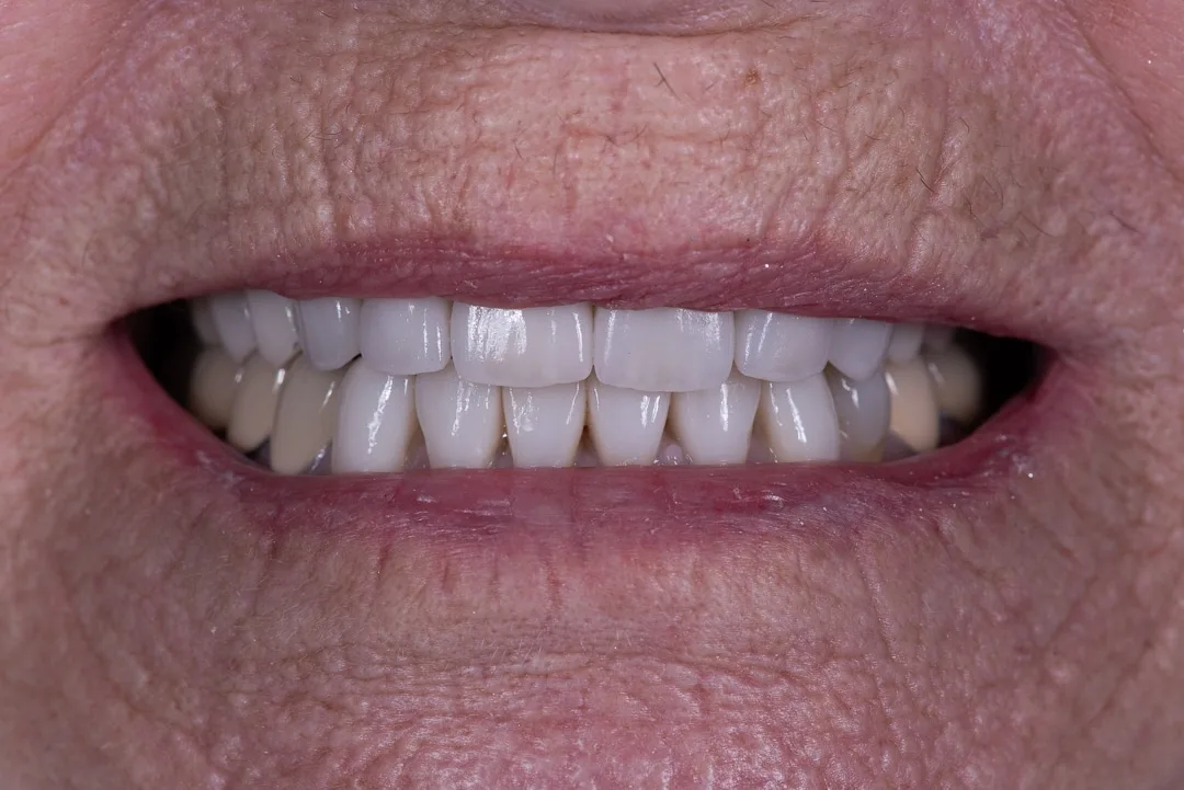05: Porcelain Veneers