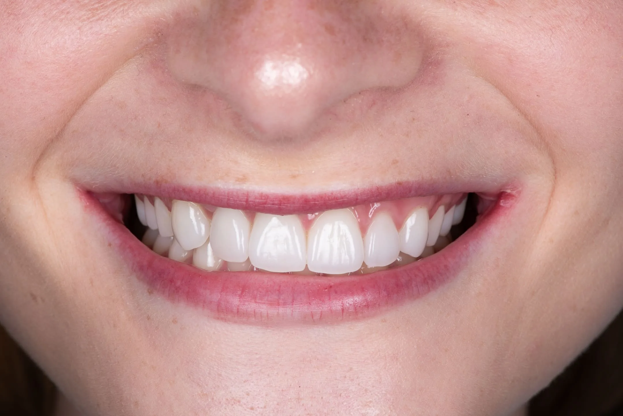 14: Bridge + Veneers