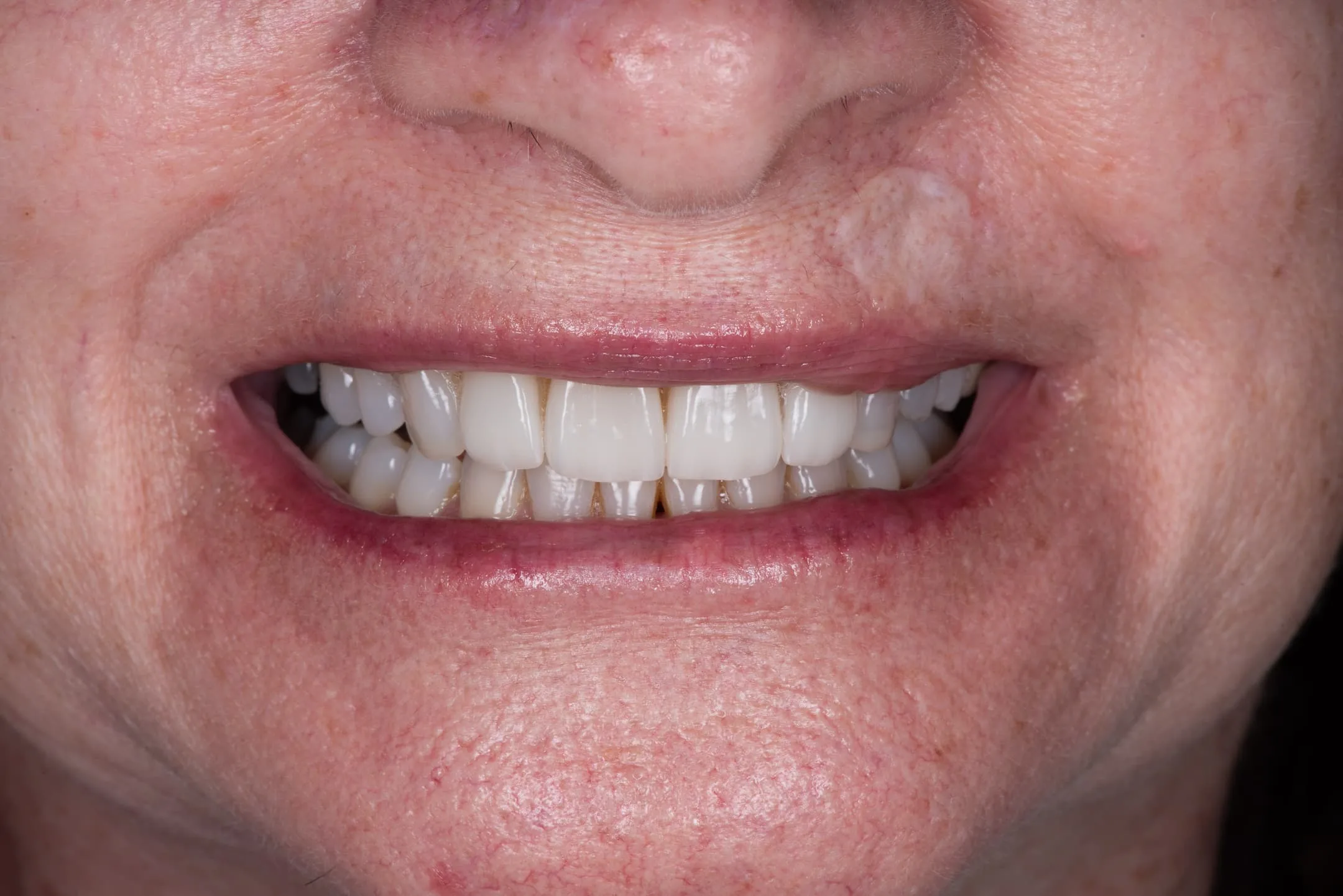 15: Porcelain Veneers
