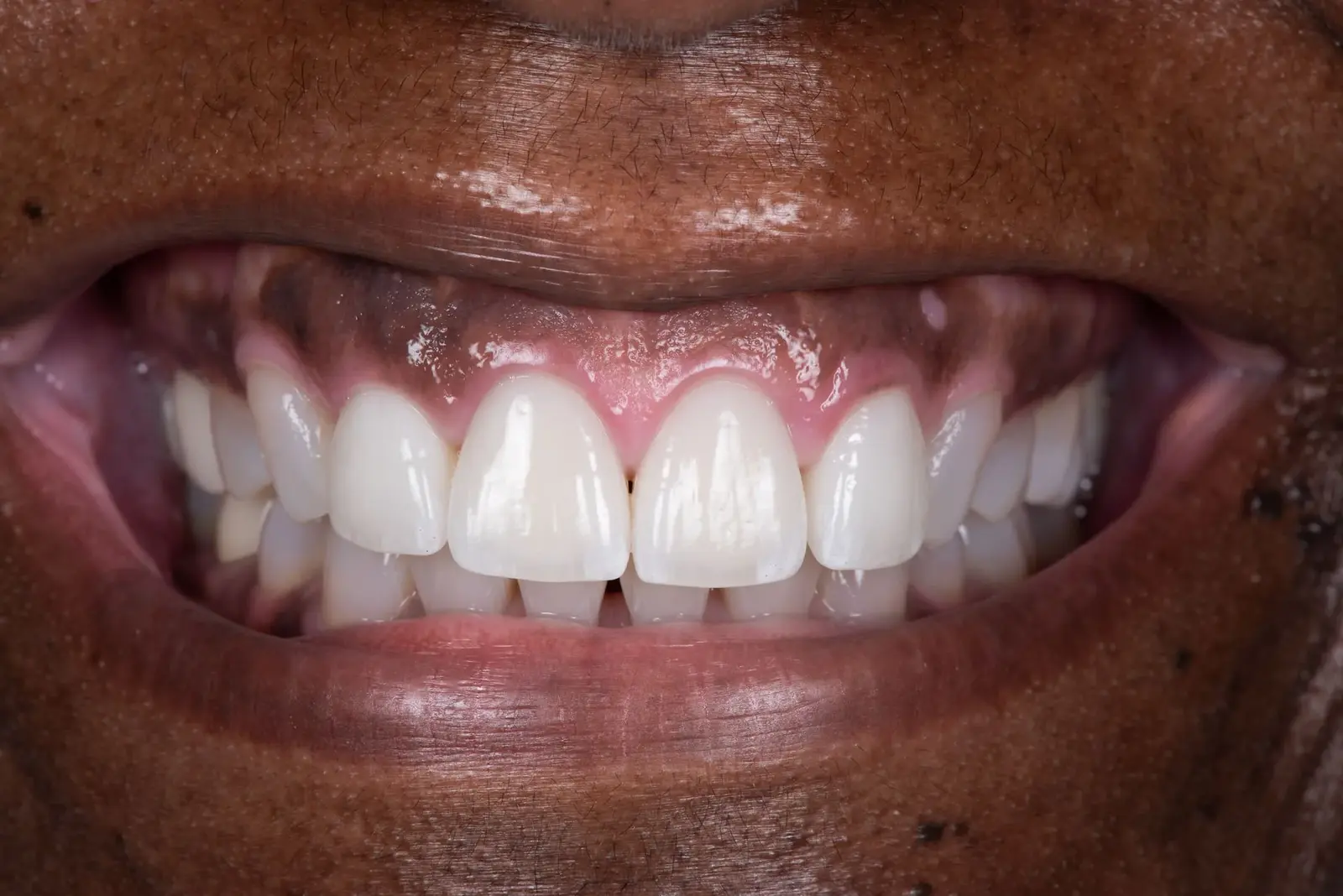 12: Porcelain Veneers