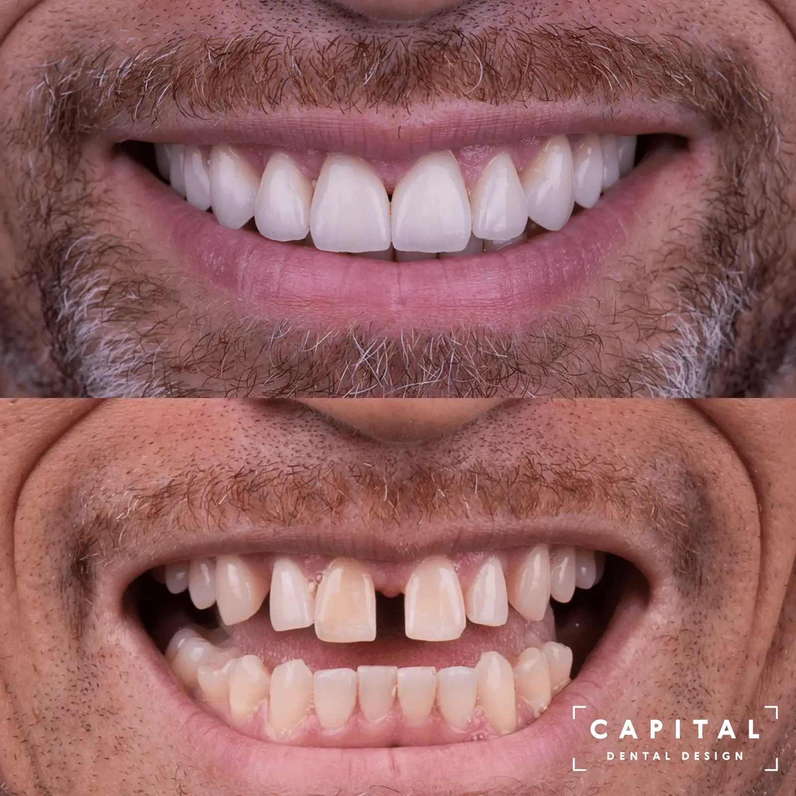 Invisalign and Veneers case