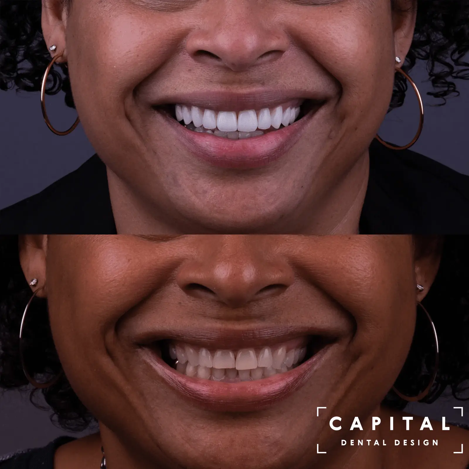 Before and after porcelain veneers - Case 1